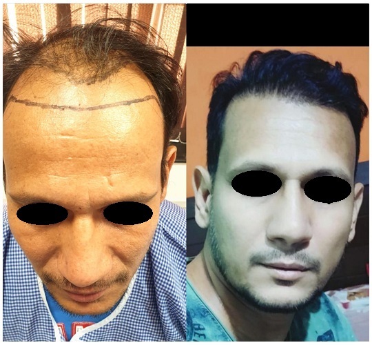 Hair Transplant Surgery In Noida